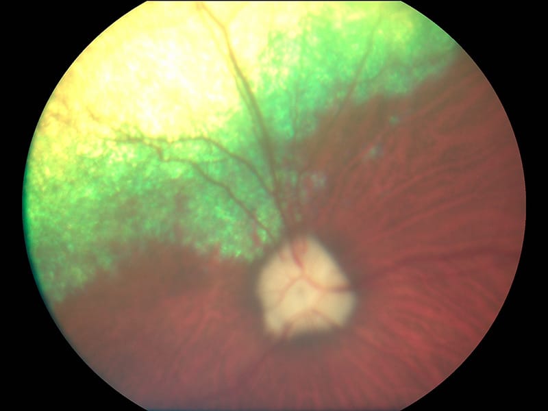 Nervio óptico previo al glaucoma Nervo