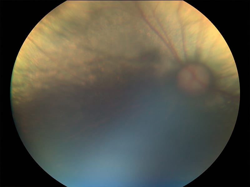 Nervio óptico previo al glaucoma