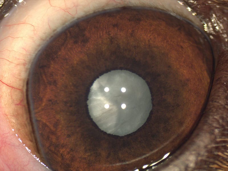 Ojo con catarata pequeña