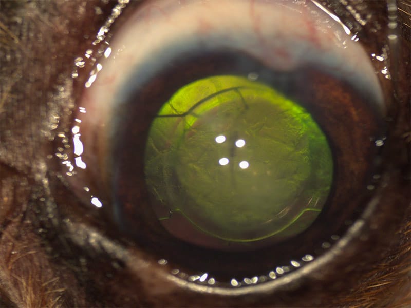 Ojo con lente intraocular