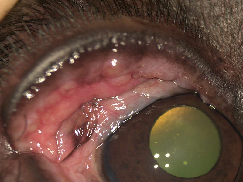 Interior de ojo con orzuelo durante una consulta
